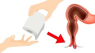 Mit diesen wunderbaren Mitteln beseitigst du Hämorrhoiden für immer!