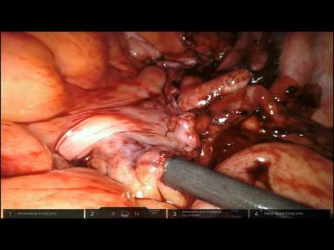 Robot-assisted Laparoscopic Cystectomy