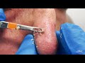 Nose Blackheads Extracted | CONTOUR DERMATOLOGY