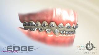 Decalcification - Due to poor hygiene with braces white spots