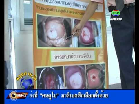ที่ทำเสริมเต้านม การผ่าตัดเสริมเต้านม 17 ปี