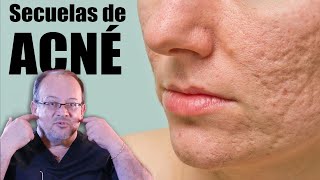 SECUELAS de ACNÉ 💔 TRATAMIENTO para ATENUAR las CICATRICES 💯 Láser CO2 🌹 DR ALBERTO CALVO QUIROZ