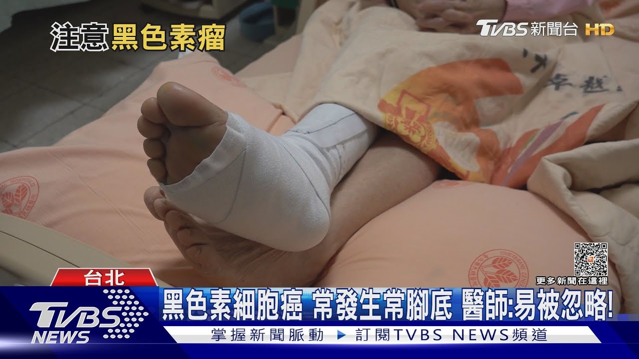 身體「這部位」出現「黑色素沉澱」 罹「黑色素瘤機率高盡速就醫!