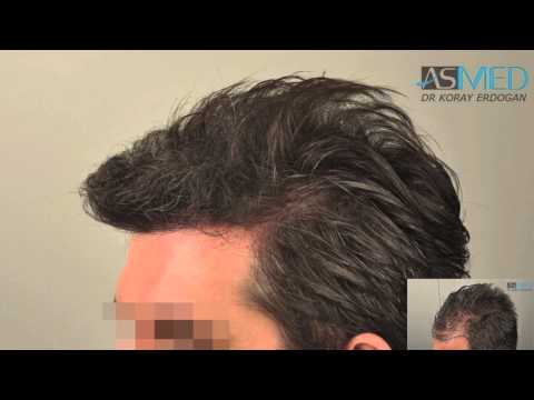 ASMED - Dr. Koray Erdogan - 2800 Grafts FUE #hairtransplant #hairtransplantturkey