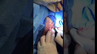 Vaginaplasty a.k.a. Labia Minora Reduction procedure