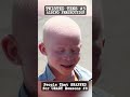 ALBINO PERSECUTION: People That SNAPPED for CRAZY Reasons #8