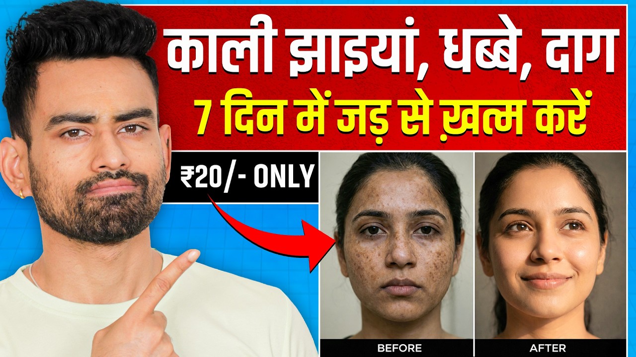 Get Rid of Skin Pigmentation in 4 Steps (No More Dark Spots/ Acne Marks)
