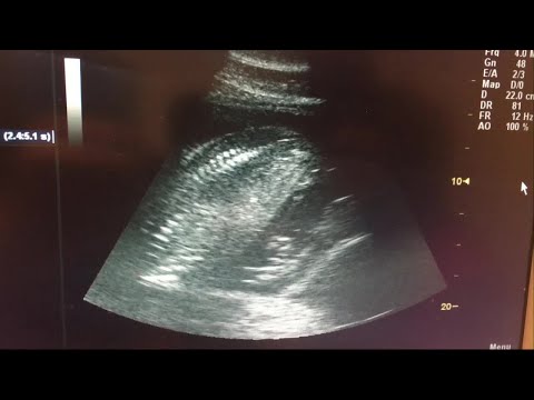 Graviditet: Värktabletter kan påverka barnets framtida fertilitet - Nyheterna (TV4)