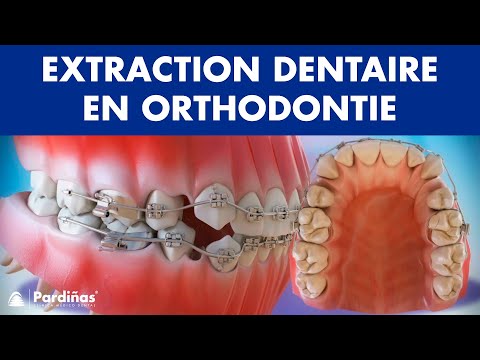 Extraction dentaire en orthodontie ©