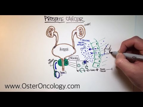 Prostate Cancer - An Illustrative Walk-Thru (A TUTORIAL from Oster Oncology)