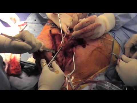 Limb-Salvage Removal Of Scapula And Proximal Humerus (Tikhoff-Linberg Intervention)