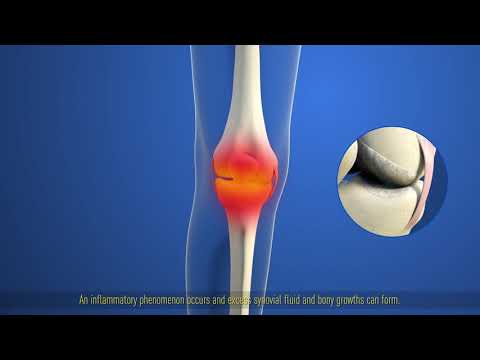 Vad är egentligen artros i knäet?