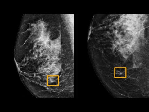 AI model improves breast cancer detection on mammograms