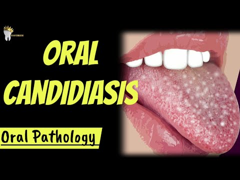 Kandydoza jamy ustnej | Klasyfikacja | Patogeneza