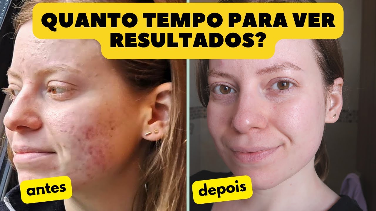 Por quanto tempo utilizar o Peróxido de Benzoíla? Quando iniciar o tratamento para as manchas?