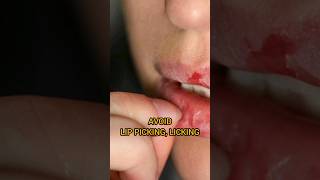 CHAPPED LIPS | SOLUTIONS | CRACKED LIPS | DRY LIPS | LIP CARE | SKIN CARE #viral