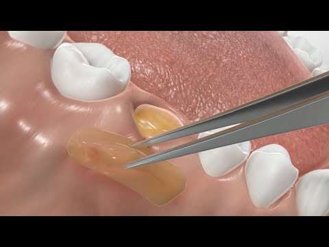 PRF Therapy (Platelet-Rich Fibrin Therapy)