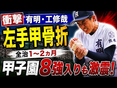 ⚾【衝撃】有明・工修哉が骨折…甲子園8強入りも大ピンチ!