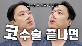 코수술 끝나고 하는 '부목+테이핑' 직접 보여드립니다.