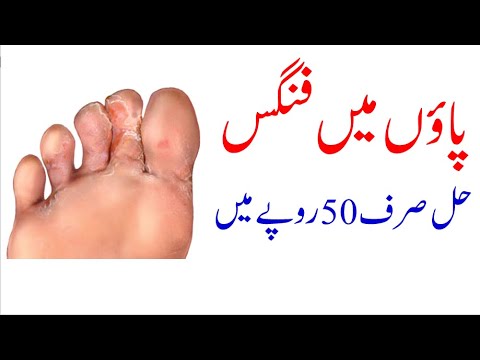 Foot fungus permanent treatment in Rs 50 only