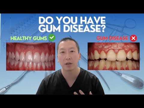 Gum Disease:  What you need to know before treatment!