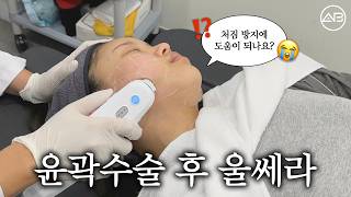 윤곽 후 탄력? 울쎄라가 답이다👍