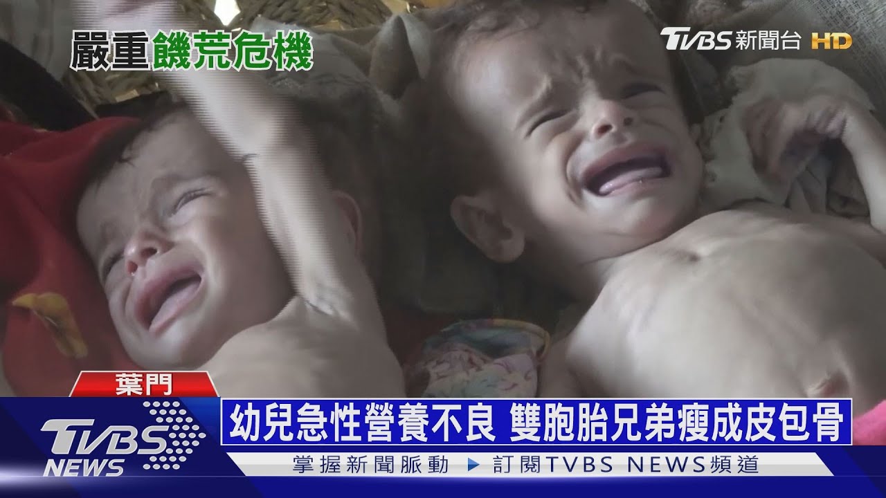 葉門內戰引發最慘饑荒 58萬幼兒營養不良
