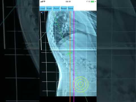 How to measure with Sagittal Balance App iOS
