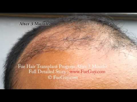 download lagu mp3 mp4 Hair Transplant After 3 Months, download lagu Hair Transplant After 3 Months gratis, unduh video klip Hair Transplant After 3 Months