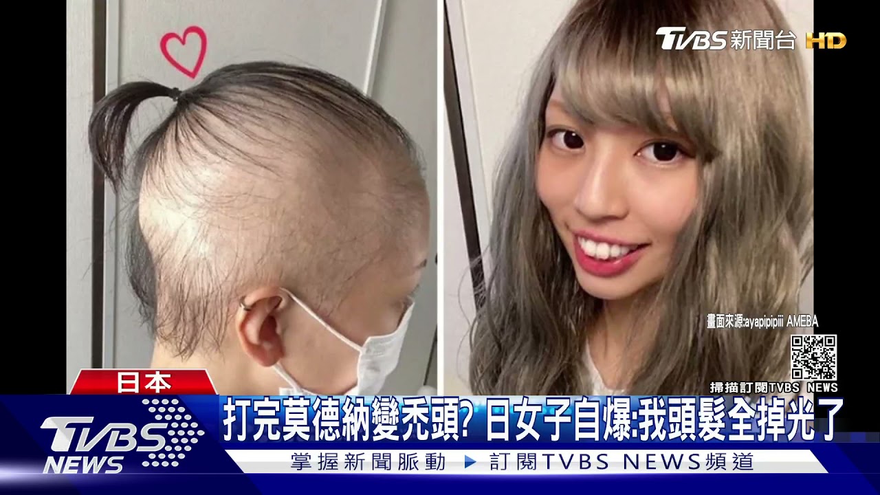 打完莫德納疫苗變禿頭? 日女子自爆:我頭髮全掉光了