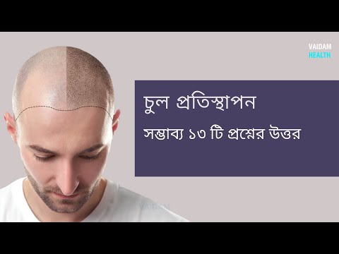 চুল প্রতিস্থাপন- ৭ টি প্রায়শই জিজ্ঞাসিত প্রশ্ন
