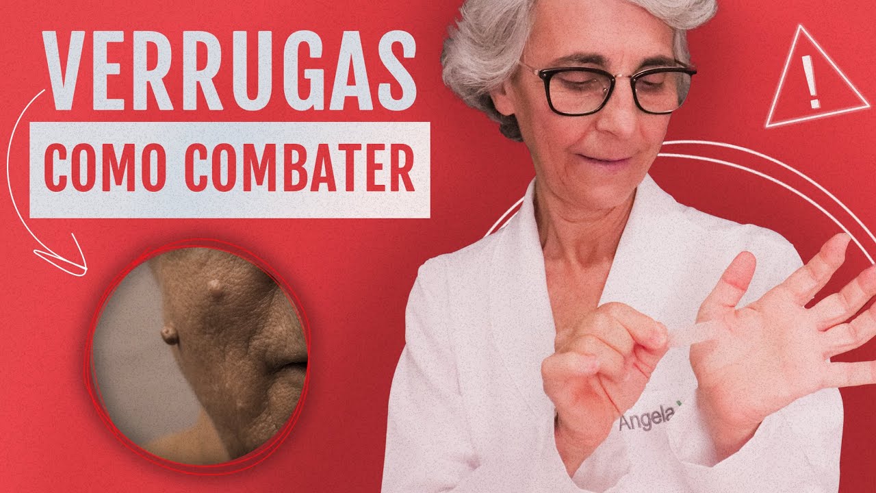 Combata as verrugas de forma simples