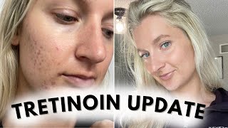 5 Month Update on Tretinoin! *How to Get Glowy Skin | Acne Prone Skin*