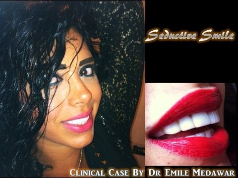 Hollywood Smile Beirut Lebanon, Dentist, Dr Emile Medawar, Style Dental Clinic