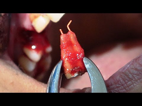 Extraction of Fake Root Canal Treated Tooth | Broken File 
