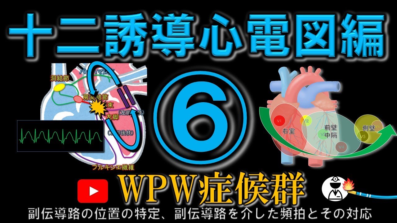 WPW症候群について(副伝導路の3つの型、副伝導路を介した頻拍)