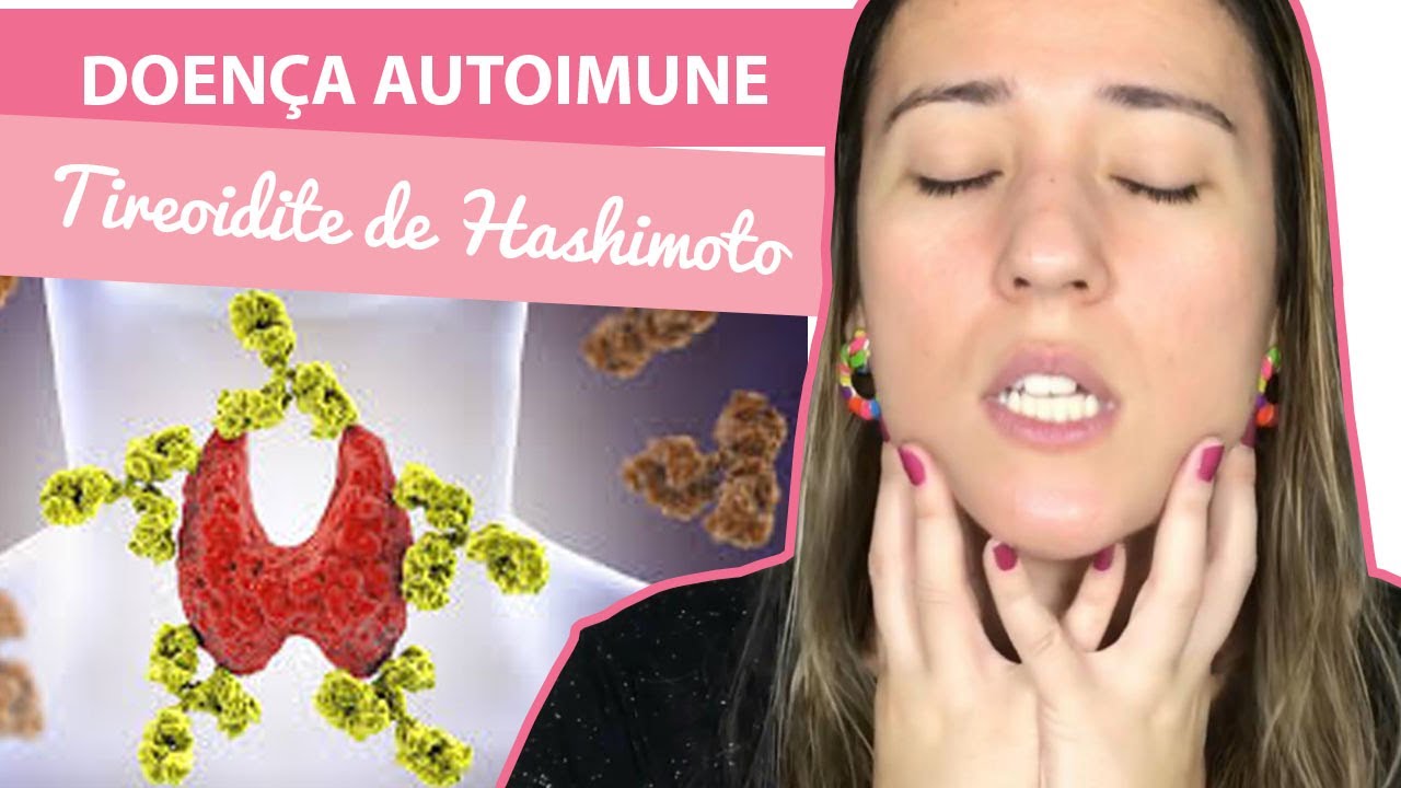 Vencendo a Doença Autoimune! Tireoidite de Hashimoto