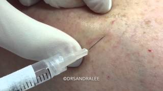 Sclerotherapy (treating spider veins) on the legs. For medical education- NSFE.