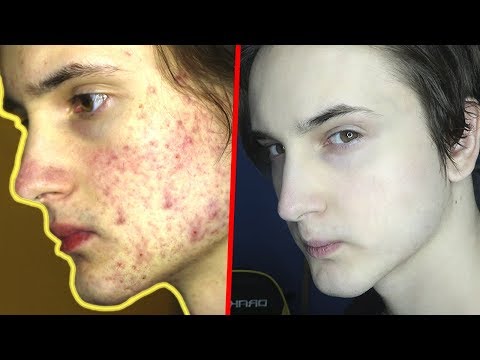 От кручения обруча болит шея Начальные дегенеративные изменения шейного отдела позвоночника