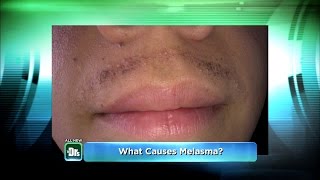 My Humiliating Melasma Mustache on The Doctors