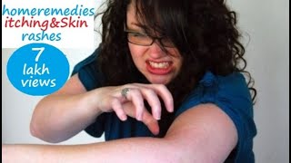 Home Remedies to Cure and Prevent Itching and Skin Rashes II Allergic Reaction II Relieve Itchy Skin
