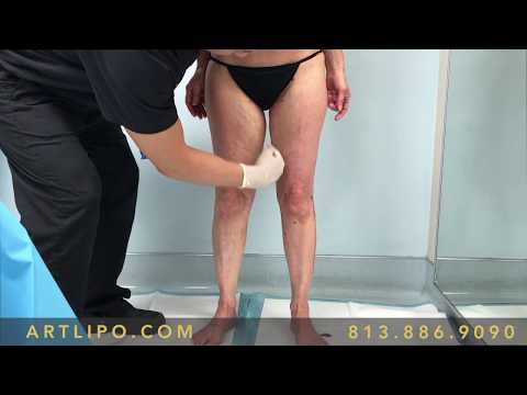 3 immediatamente osteocondrosi Articolazioni crepitano vertebra cervicale