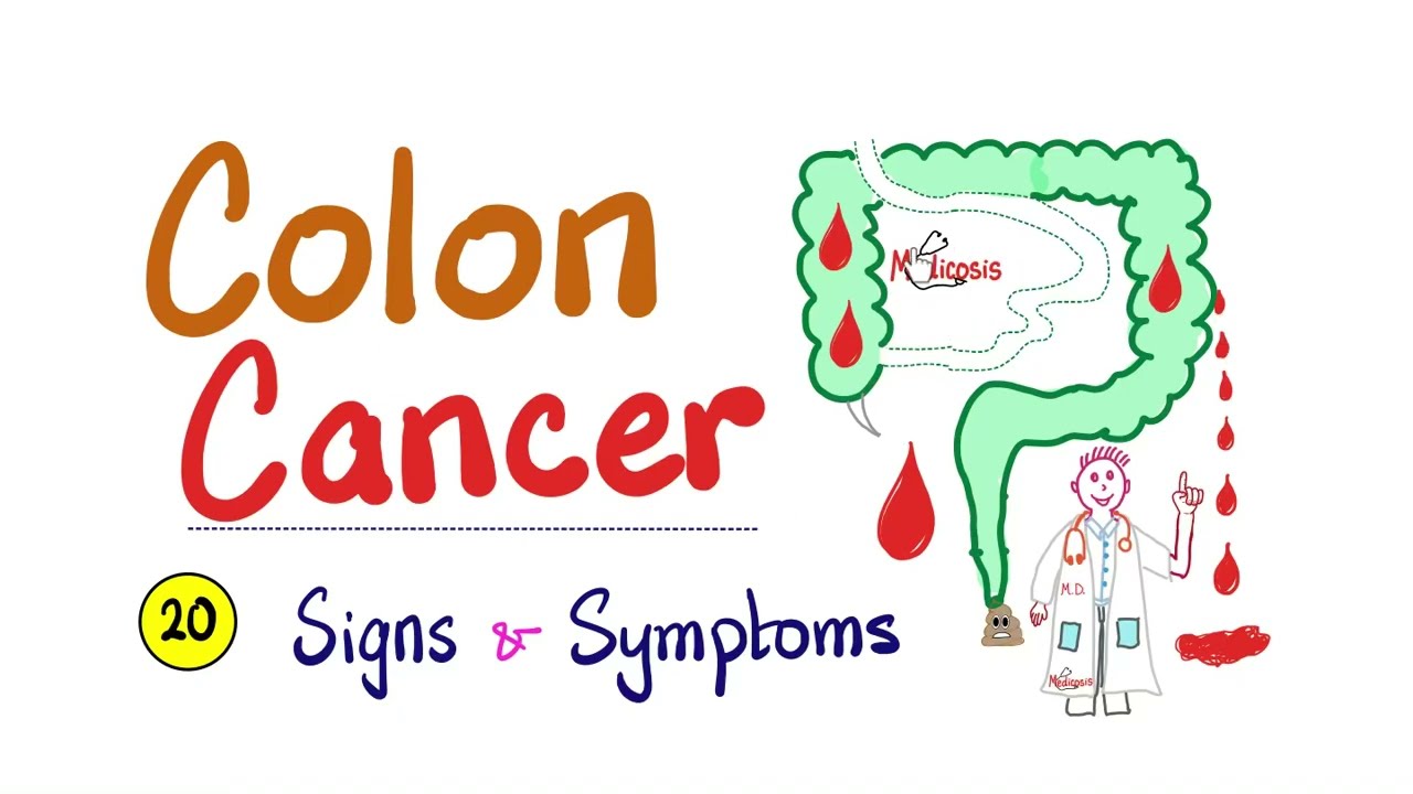 Colon cancer - 20 Signs & Symptoms - Clearly Explained - Cancer Series