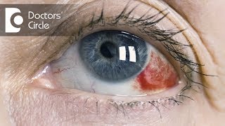 I have noticed small blood vessels in my eyes, what should I do - Dr. Sriram Ramalingam