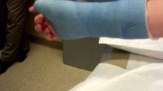 preview picture of video 'finallyyy getting my cast off'