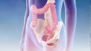 preview picture of video 'Fecal Incontinence - Interstim Bowel Mechanism of Action'