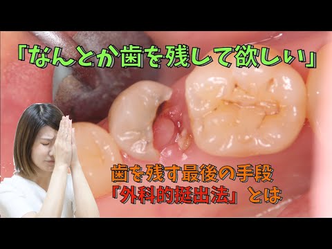 生命歯学科 大きなむし歯で抜歯と言われたなんとか残して欲しい　最後の手段「外科的挺出法」とは