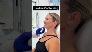 Jawline contouring using fillers