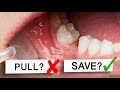 Can Loose Teeth Be Saved To Pull Or Not To Pull
