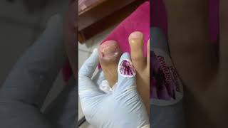 Ep_8468 Ingrown toenail removal 👣 ดึงเนื้อ..ดึงเพื่ออะไรคะ 😄 (clip from Thailand)